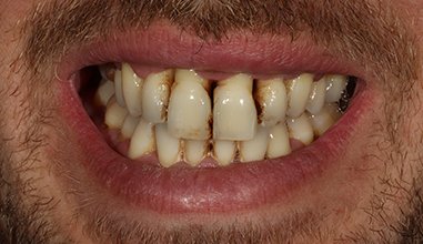 Before - Natural Smiles Implant & Cosmetic Dentistry