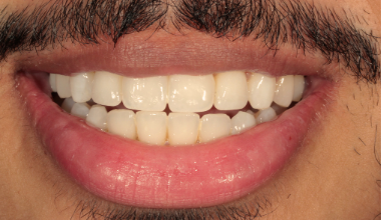 After - Natural Smiles Implant & Cosmetic Dentistry