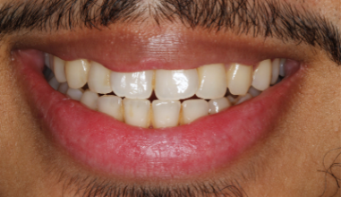 Before - Natural Smiles Implant & Cosmetic Dentistry