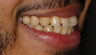 Before - Natural Smiles Implant & Cosmetic Dentistry