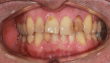 Before - Natural Smiles Implant & Cosmetic Dentistry