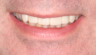 After - Natural Smiles Implant & Cosmetic Dentistry