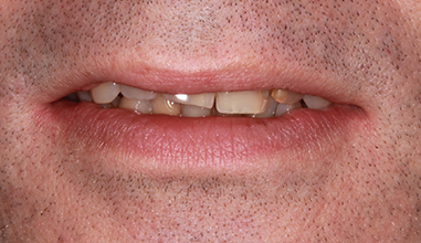 Before - Natural Smiles Implant & Cosmetic Dentistry