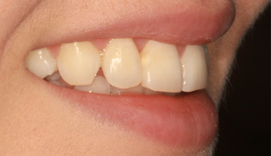 After - Natural Smiles Implant & Cosmetic Dentistry
