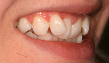 Before - Natural Smiles Implant & Cosmetic Dentistry