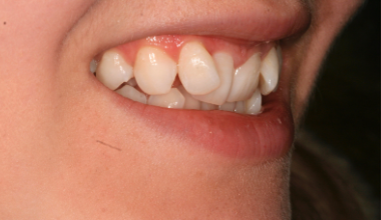Before - Natural Smiles Implant & Cosmetic Dentistry
