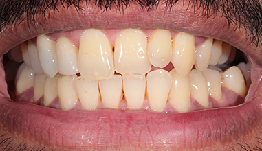 After - Natural Smiles Implant & Cosmetic Dentistry