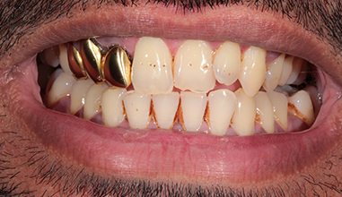 Before - Natural Smiles Implant & Cosmetic Dentistry