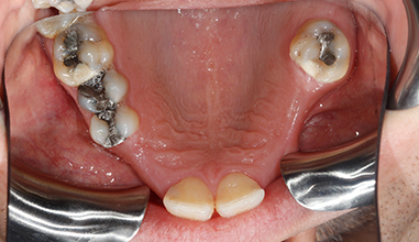 Before - Natural Smiles Implant & Cosmetic Dentistry