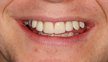 After - Natural Smiles Implant & Cosmetic Dentistry