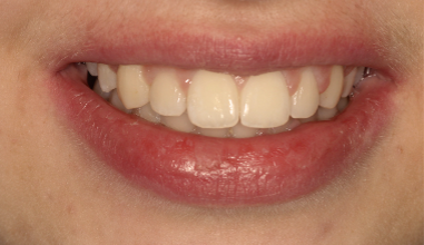 After - Natural Smiles Implant & Cosmetic Dentistry