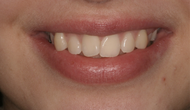 Before - Natural Smiles Implant & Cosmetic Dentistry