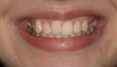 Before - Natural Smiles Implant & Cosmetic Dentistry