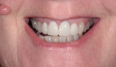 After - Natural Smiles Implant & Cosmetic Dentistry