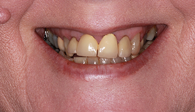 Before - Natural Smiles Implant & Cosmetic Dentistry