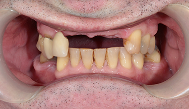 Before - Natural Smiles Implant & Cosmetic Dentistry