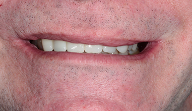 After - Natural Smiles Implant & Cosmetic Dentistry