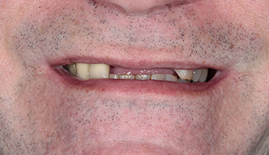 Before - Natural Smiles Implant & Cosmetic Dentistry