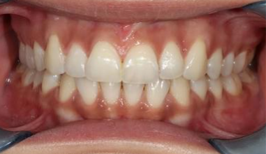 After - Natural Smiles Implant & Cosmetic Dentistry