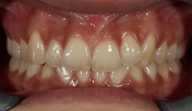 Before - Natural Smiles Implant & Cosmetic Dentistry
