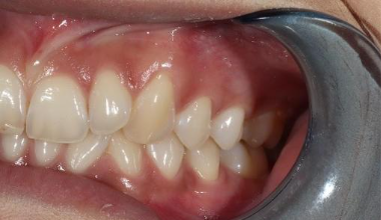 Before - Natural Smiles Implant & Cosmetic Dentistry