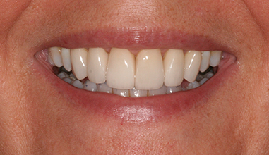 After - Natural Smiles Implant & Cosmetic Dentistry