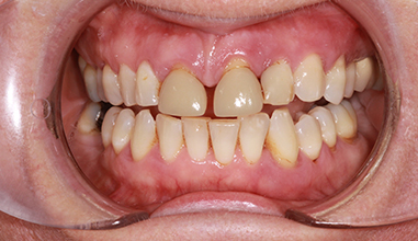 Before - Natural Smiles Implant & Cosmetic Dentistry
