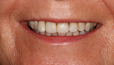 After - Natural Smiles Implant & Cosmetic Dentistry