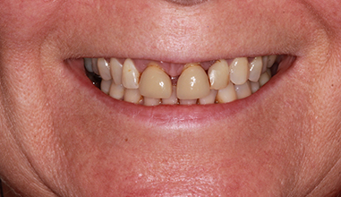 Before - Natural Smiles Implant & Cosmetic Dentistry