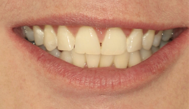 After - Natural Smiles Implant & Cosmetic Dentistry