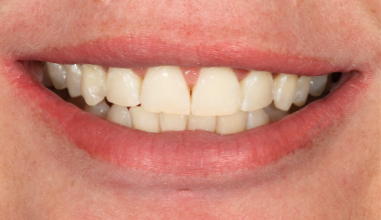 Before - Natural Smiles Implant & Cosmetic Dentistry