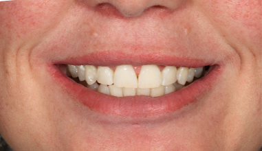 Before - Natural Smiles Implant & Cosmetic Dentistry