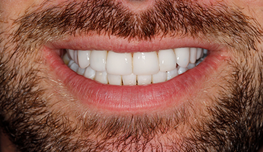 After - Natural Smiles Implant & Cosmetic Dentistry