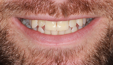 Before - Natural Smiles Implant & Cosmetic Dentistry