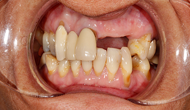 Before - Natural Smiles Implant & Cosmetic Dentistry