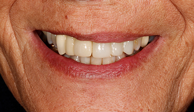 After - Natural Smiles Implant & Cosmetic Dentistry