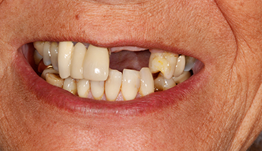 Before - Natural Smiles Implant & Cosmetic Dentistry