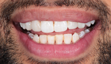After - Natural Smiles Implant & Cosmetic Dentistry