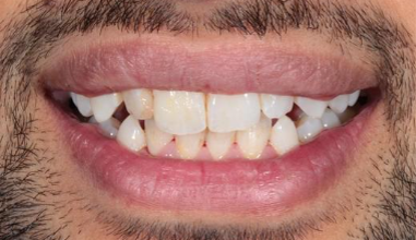 Before - Natural Smiles Implant & Cosmetic Dentistry