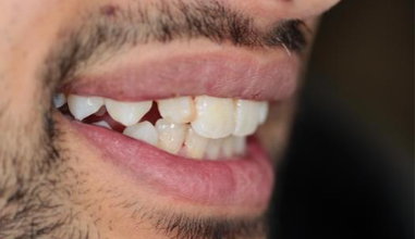 Before - Natural Smiles Implant & Cosmetic Dentistry