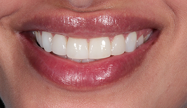 After - Natural Smiles Implant & Cosmetic Dentistry