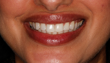 Before - Natural Smiles Implant & Cosmetic Dentistry