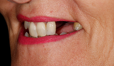 Before - Natural Smiles Implant & Cosmetic Dentistry