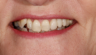 After - Natural Smiles Implant & Cosmetic Dentistry
