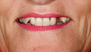 Before - Natural Smiles Implant & Cosmetic Dentistry