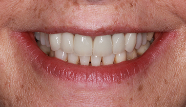 After - Natural Smiles Implant & Cosmetic Dentistry