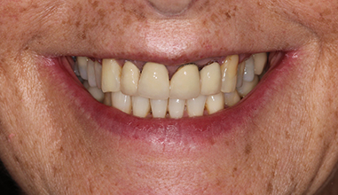 Before - Natural Smiles Implant & Cosmetic Dentistry