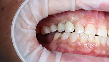After - Natural Smiles Implant & Cosmetic Dentistry