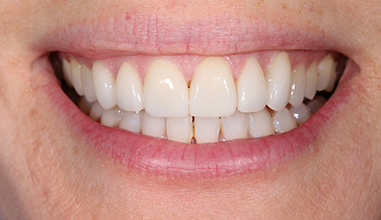 After - Natural Smiles Implant & Cosmetic Dentistry