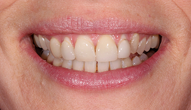 Before - Natural Smiles Implant & Cosmetic Dentistry